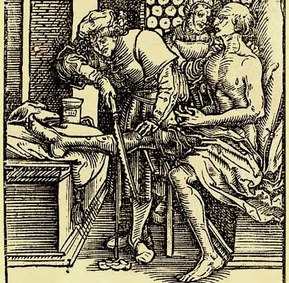 Beenamputatie. Hans Weiditz. Houtsnede, 1531. Cicero 'Officia' . Londen, British Museum.